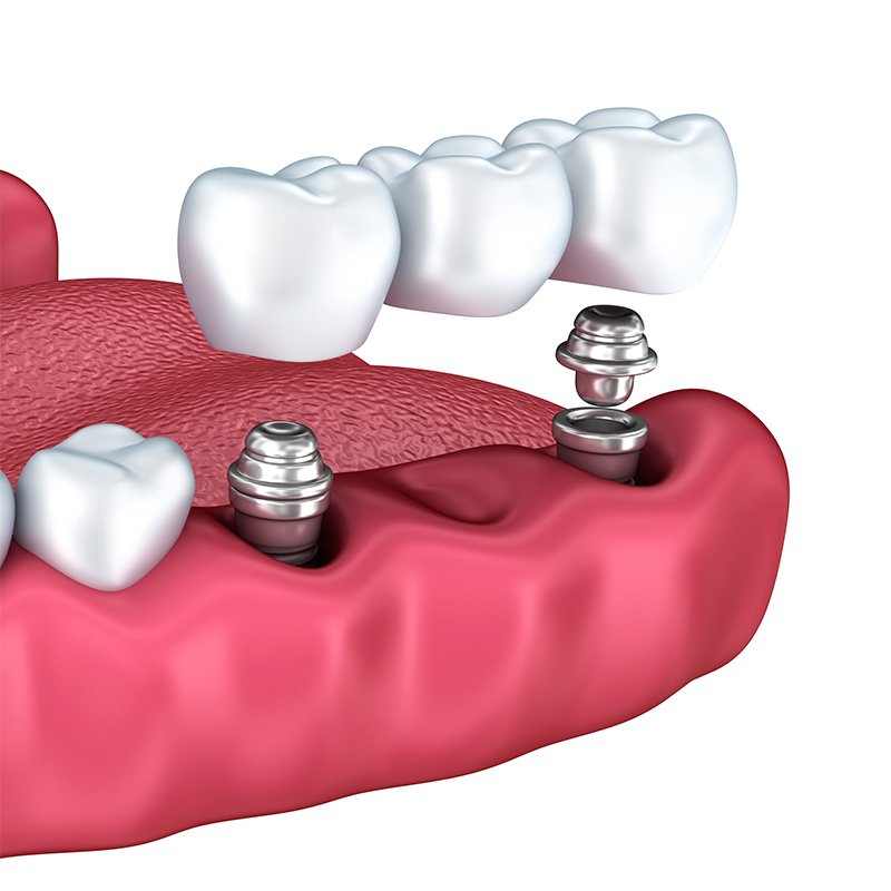 Odontica Dental Clinic | Dental Implants